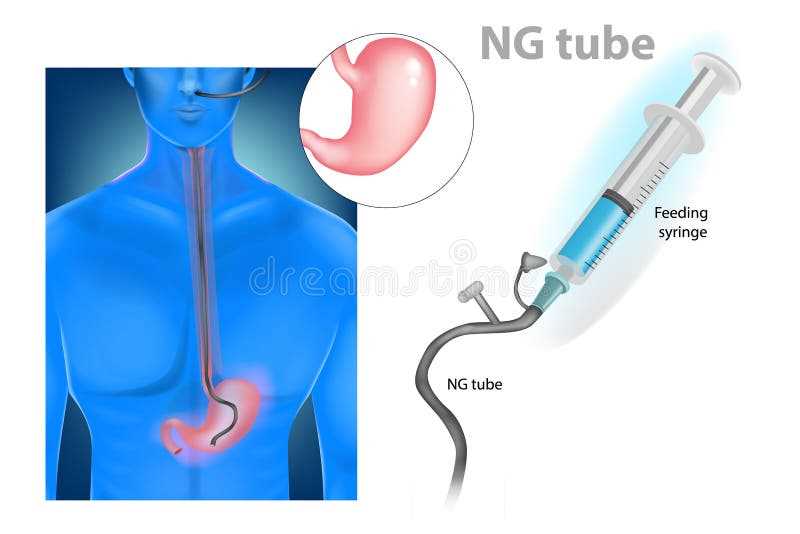 The Essential Guide To Ati Nasogastric Tube Posttest Everything You